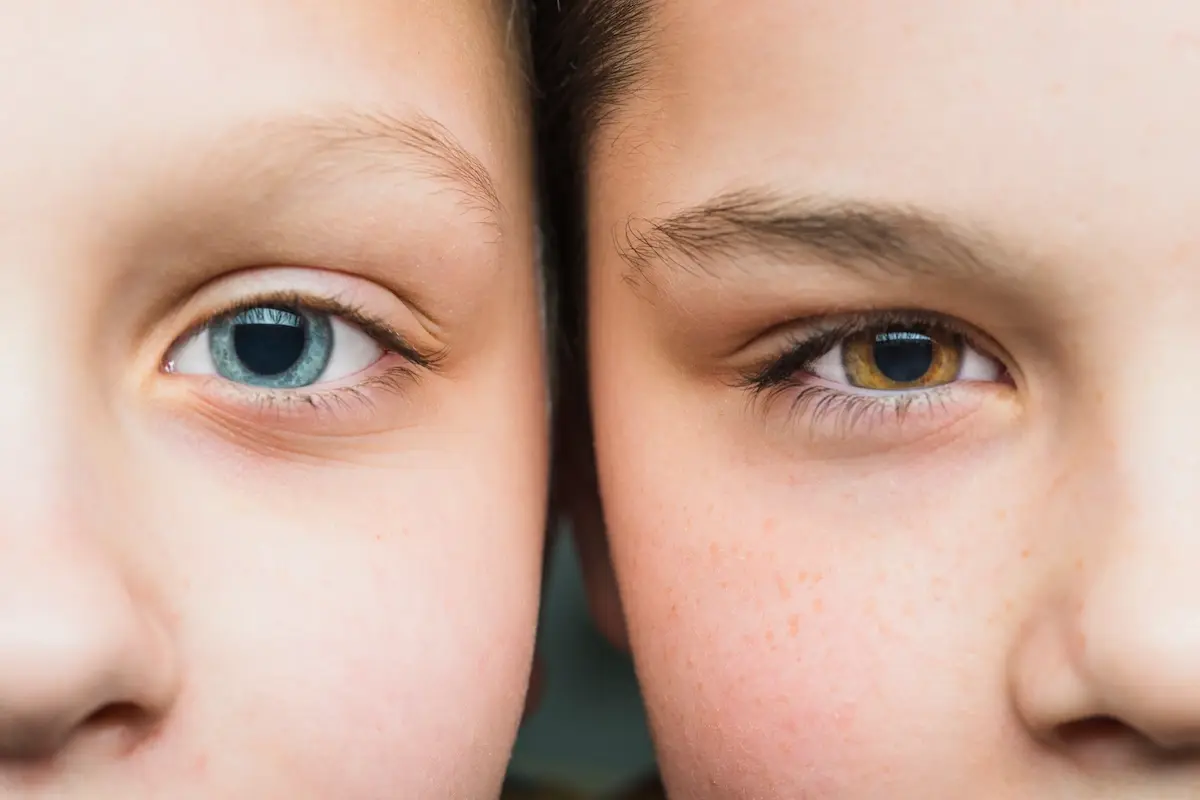 Cirugía LASIK Miopía CDMX