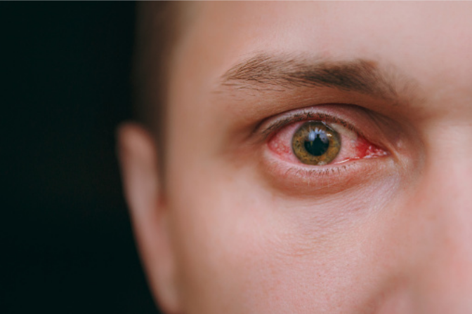 Derrame ocular: Qué es, causas y tratamiento