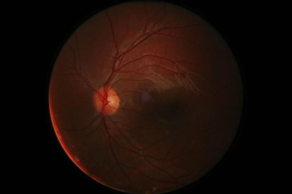 ¿Qué es la neuritis óptica?