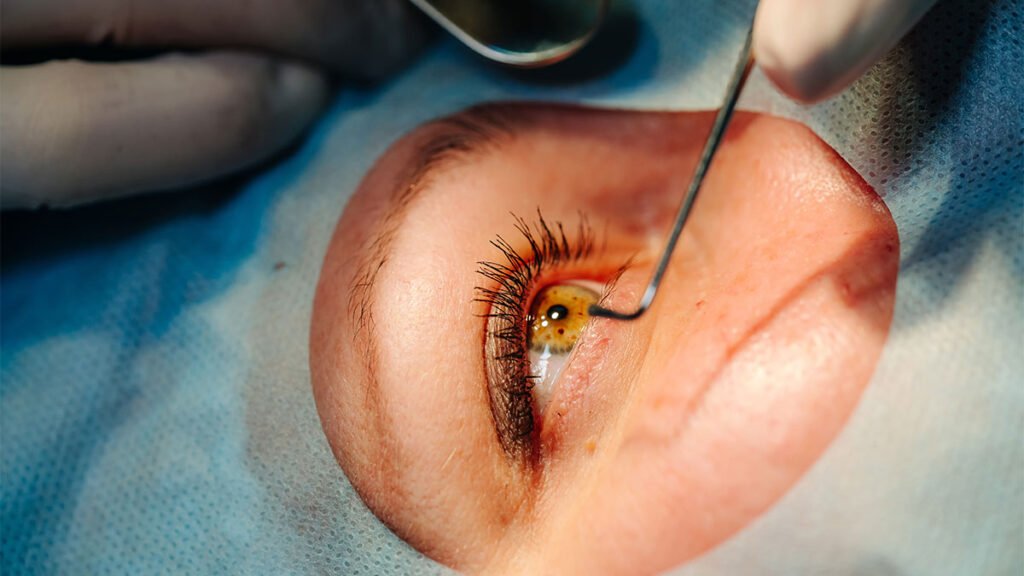 Cirugía de Queratoplastia: Todo lo que necesitas saber sobre el trasplante de córnea