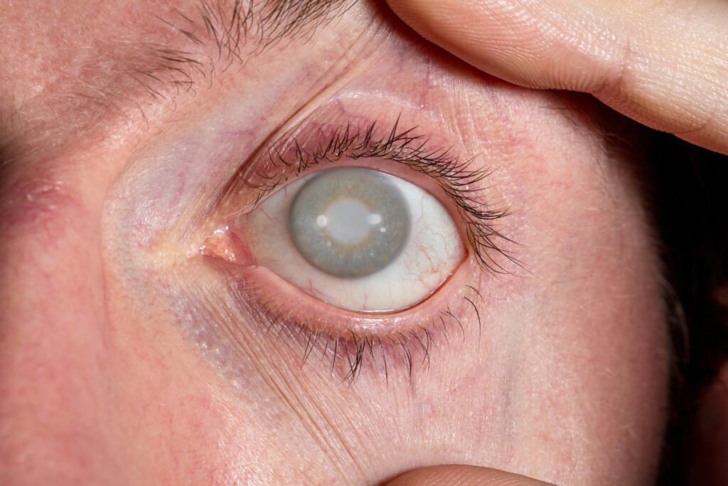 Cataratas y glaucoma: ¿se pueden operar al mismo tiempo?