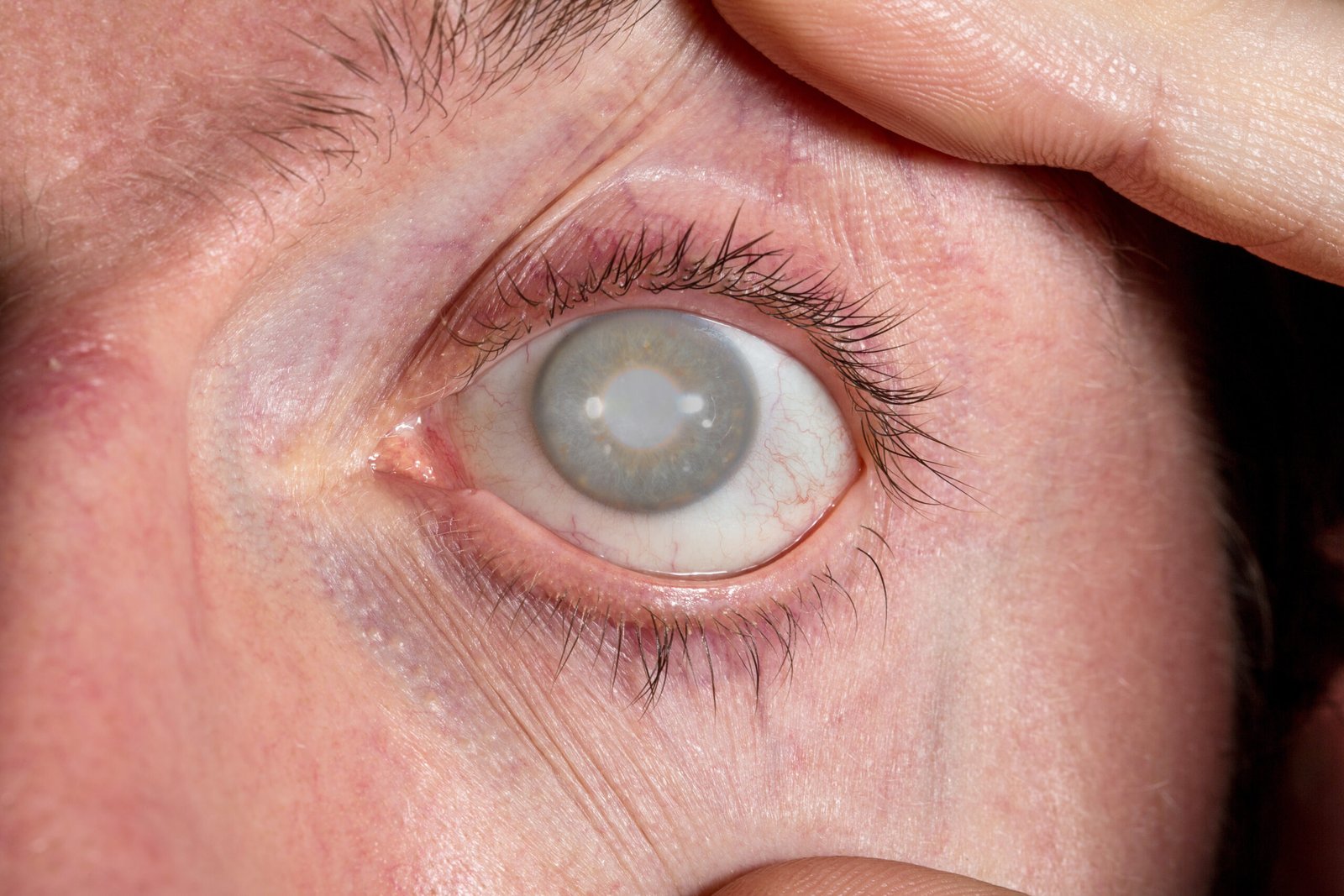 Cataratas y glaucoma
