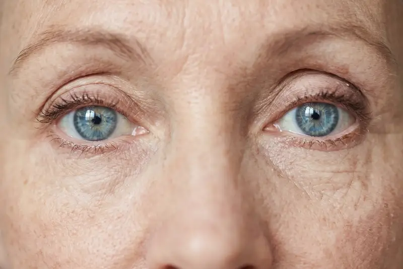 Corrección de Astigmatismo LASIK Roma Norte