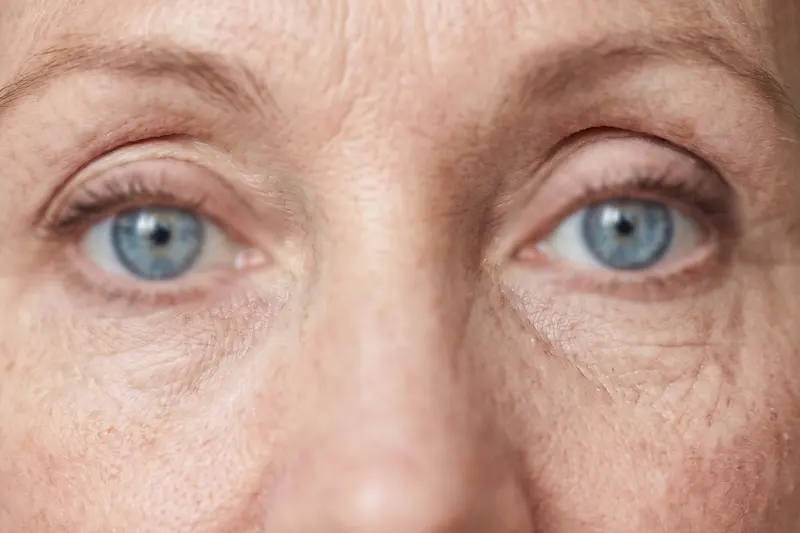 Cirugía LASIK Miopía Cuauhtémoc CDMX
