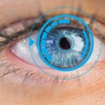 Cataratas y astigmatismo: corrección simultánea con lente tórico